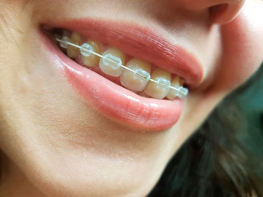 ceramic-braces