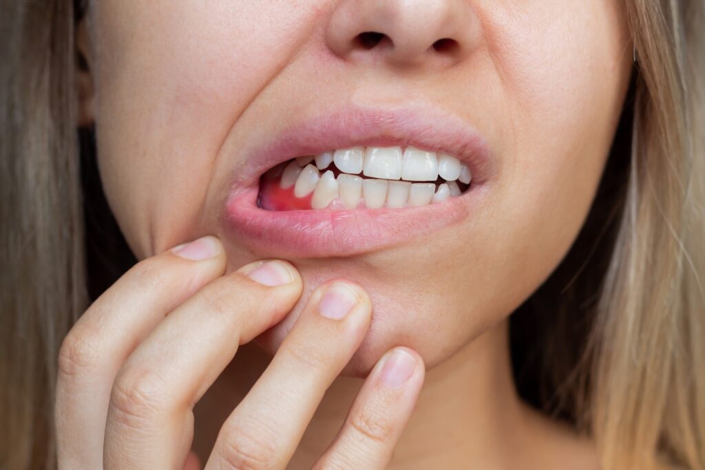 Gum bleeding